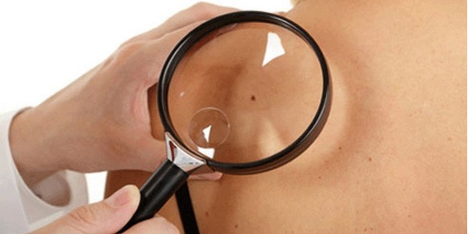 Cilt kanserinde korkutan yaş